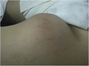 Monophasic Synovial Sarcoma