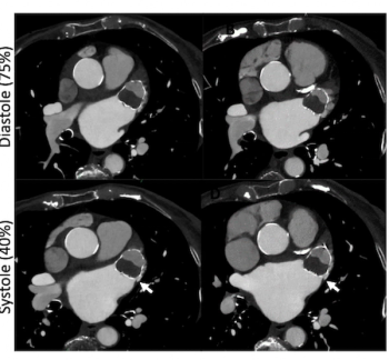 Can Cardiac CTA be a Viable Alternative for Post-Op Assessment of Left Atrial Appendage (LAA) Closure?