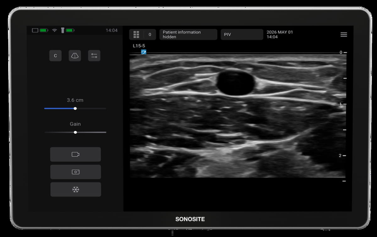 Could an Emerging Ultrasound Device Facilitate More Efficient Vascular Access Workflows?