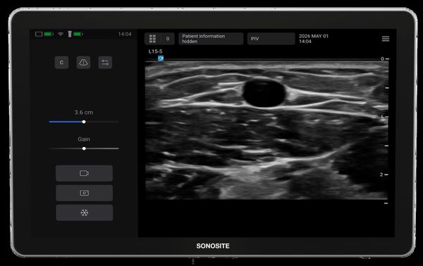 Could an Emerging Ultrasound Device Facilitate More Efficient Vascular Access Workflows?