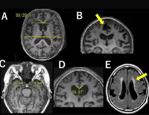 MRI Study Links Tightness of High-Convexity Sulci to Higher Risk of Cognitive Decline in Older Adults