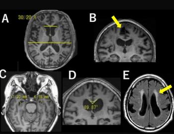 MRI Study Links Tightness of High-Convexity Sulci to Higher Risk of Cognitive Decline in Older Adults