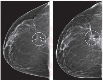 Mammography Surveillance: Can Screening DBT Have an Impact After Breast Cancer Treatment?