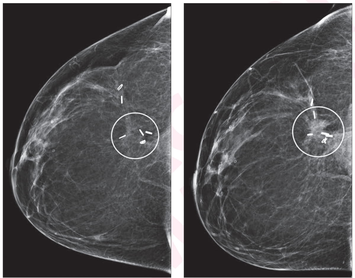 ¿Puede el cribado DBT tener algún impacto después del tratamiento del cáncer de mama?
