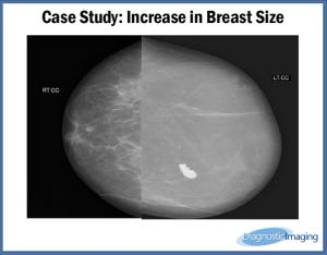 Increase in Breast Size