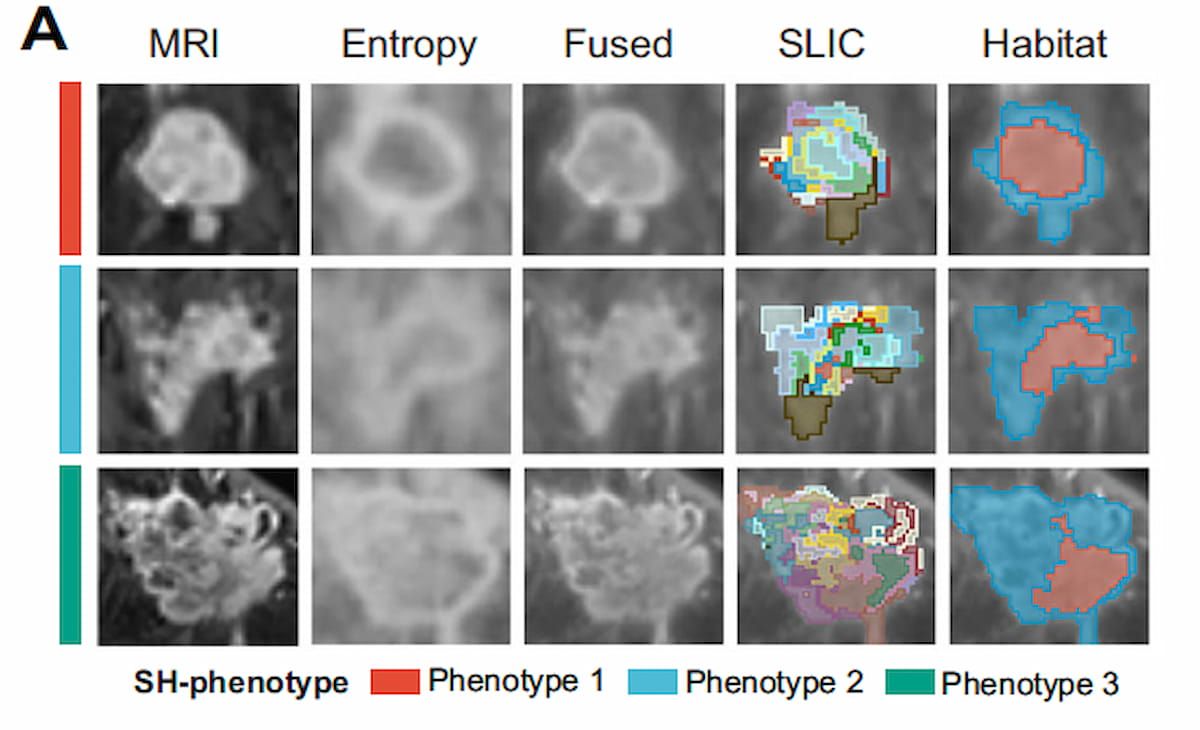Can MRI-Derived Tumor Habitat Subregions Bolster Recurrence Risk Stratification in Stage 2 and 3 Breast Cancer Cases?
