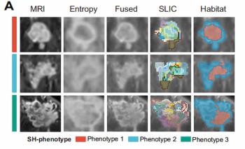 Can MRI-Derived Tumor Habitat Subregions Bolster Recurrence Risk Stratification in Stage 2 and 3 Breast Cancer Cases?