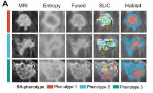 Can MRI-Derived Tumor Habitat Subregions Bolster Recurrence Risk Stratification in Stage 2 and 3 Breast Cancer Cases?