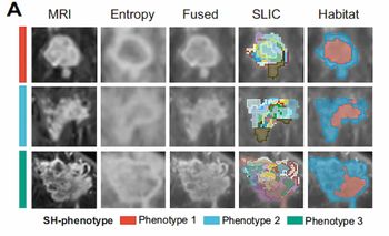 Can MRI-Derived Tumor Habitat Subregions Bolster Recurrence Risk Stratification in Stage 2 and 3 Breast Cancer Cases?