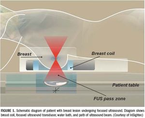 MR-guided ultrasound  ablation gains ground