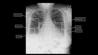 FDA Clears Emerging AI-Powered CXR Software from Qure.ai