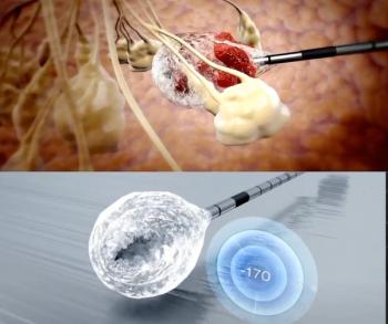 FDA Grants De Novo Approval for Cryoablation Treatment of Breast Cancer