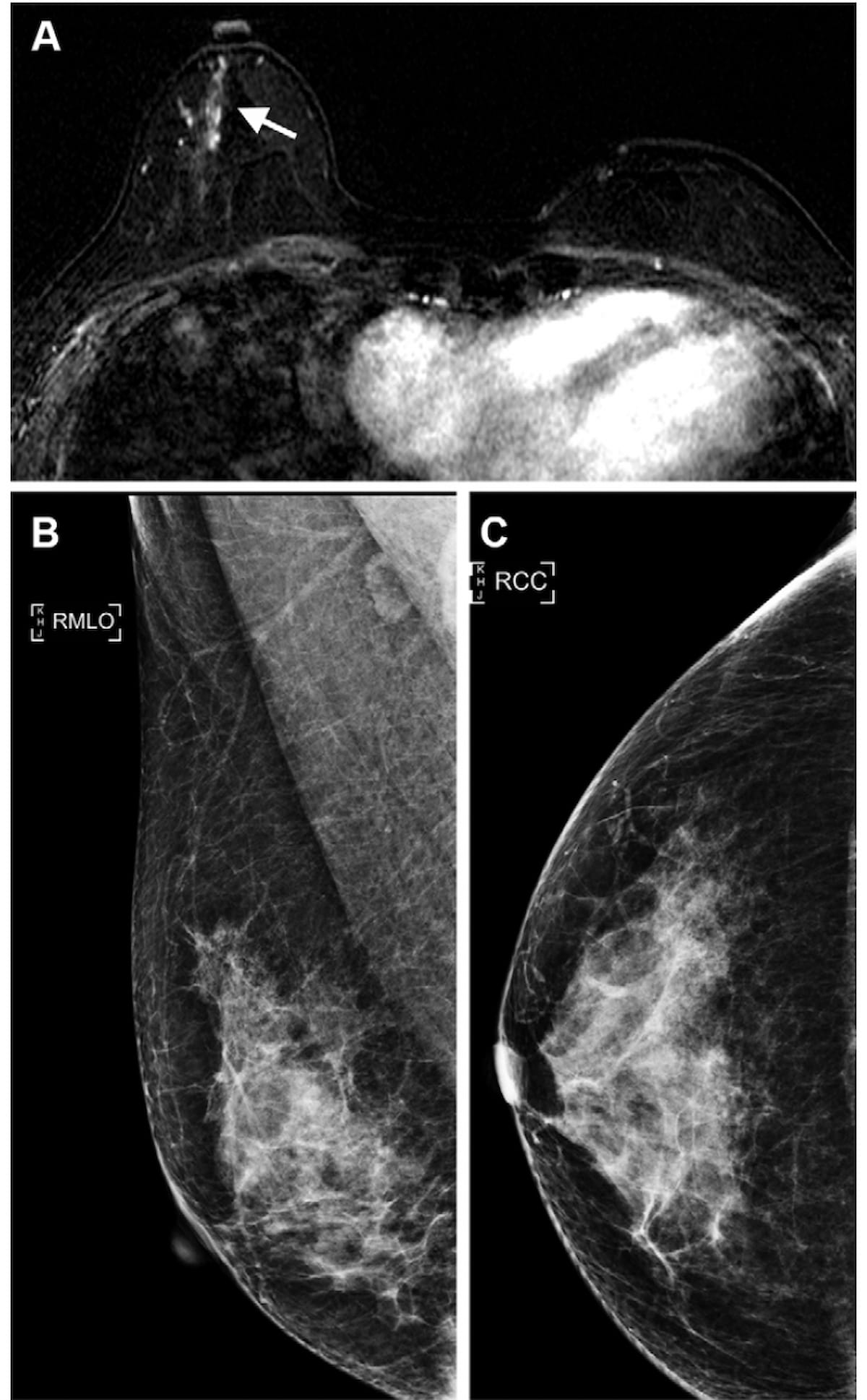 Surveillance Breast MRI Associated with Lower Risks of Advanced