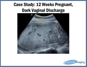 12 Weeks Pregnant, Dark Vaginal Discharge
