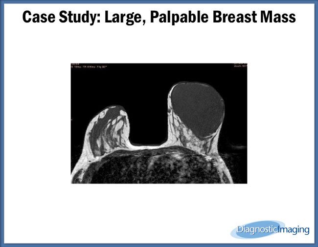 large-palpable-breast-mass