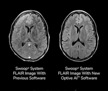FDA Clears Next-Generation AI Software for Portable Brain MRI