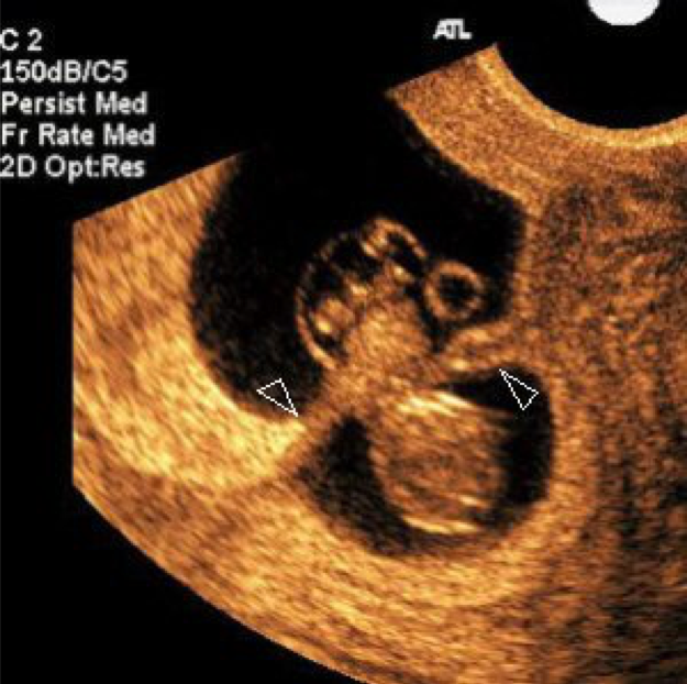Recognizing Intraamniotic Bandlike Structures on Obstetric Ultrasound