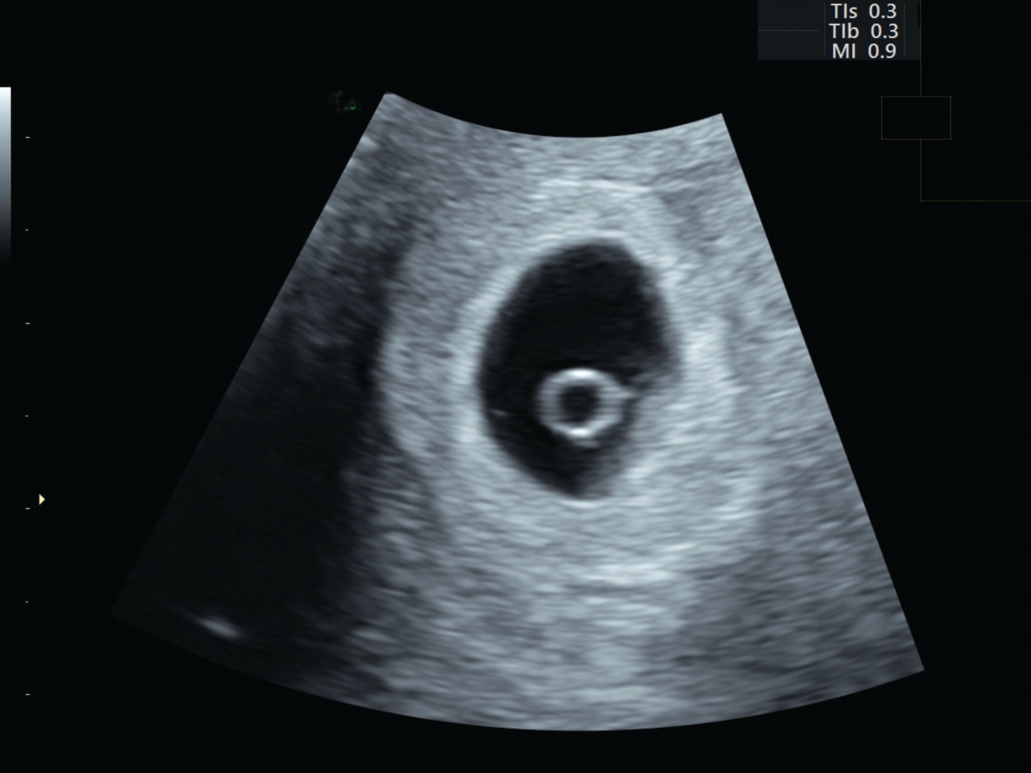 Weeks 4 ultrasound at WHAT CAN