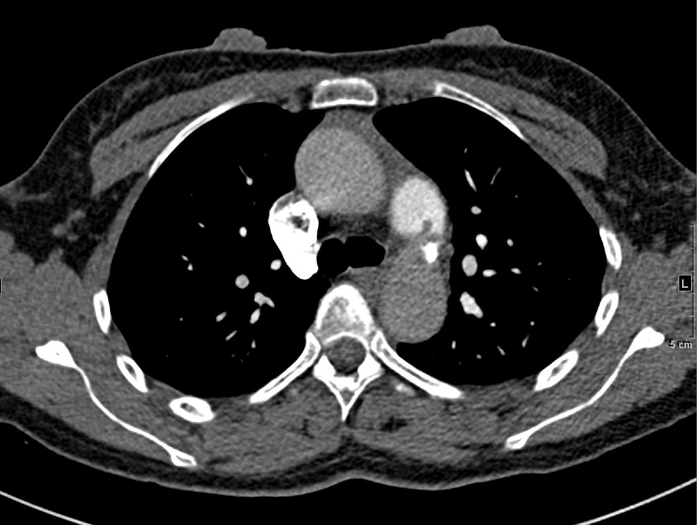 Image IQ Quiz: Acute Chest and Epigastric Pain in a 50-Year-Old Female