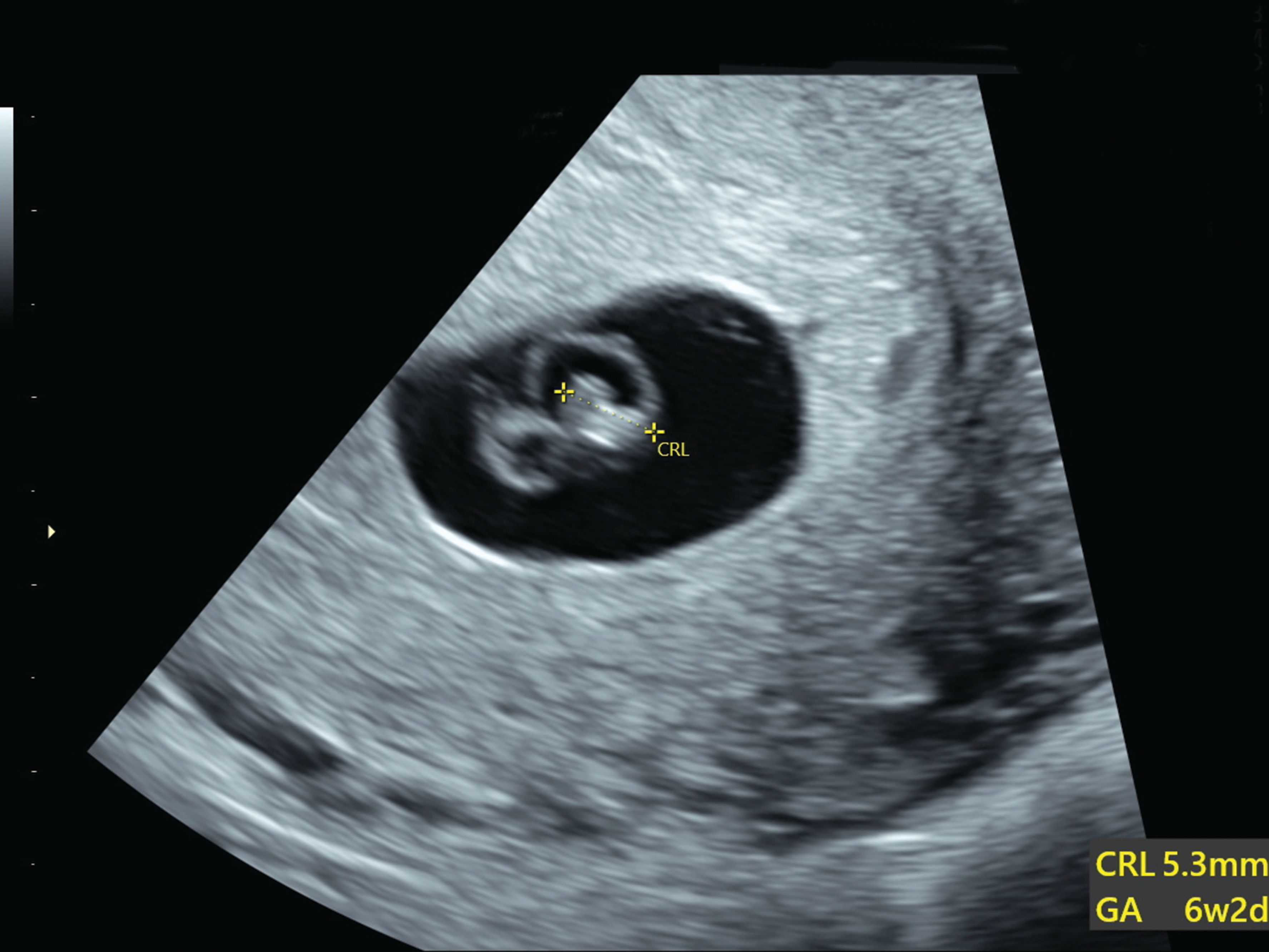 Miscarriage At 6 Weeks: Words Of Hope & Understanding - biymsht