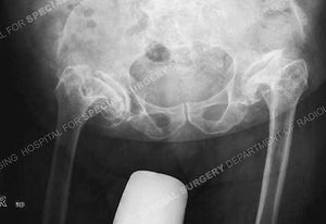 Spondyloepiphyseal Dysplasia (SED)
