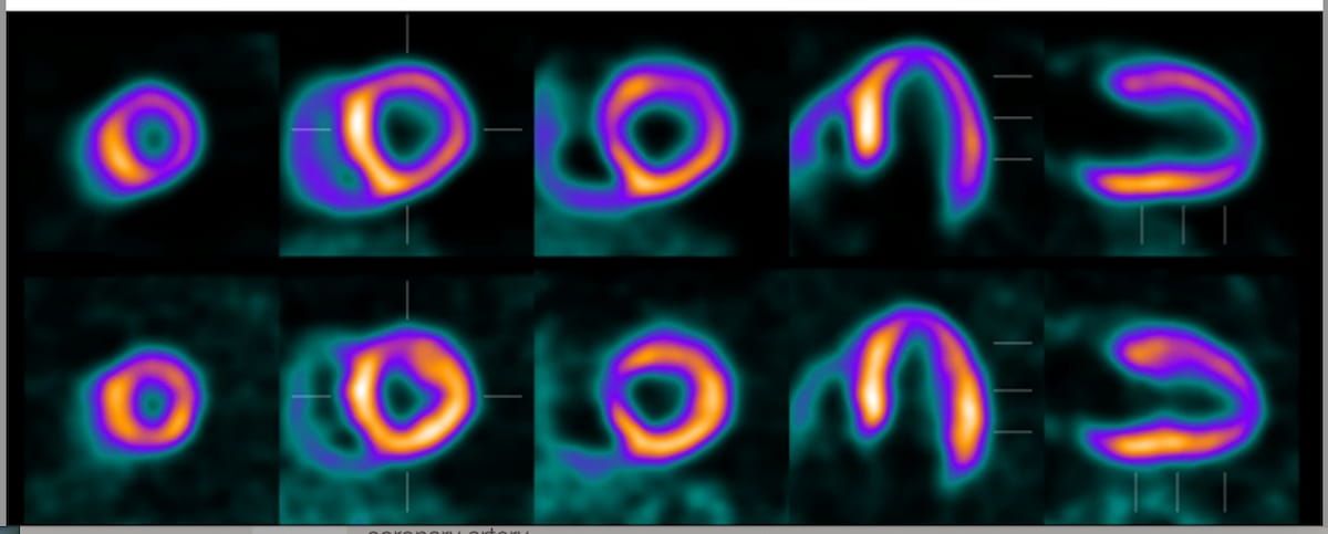Nine Takeaways from New Guidelines on PET Myocardial Perfusion Imaging