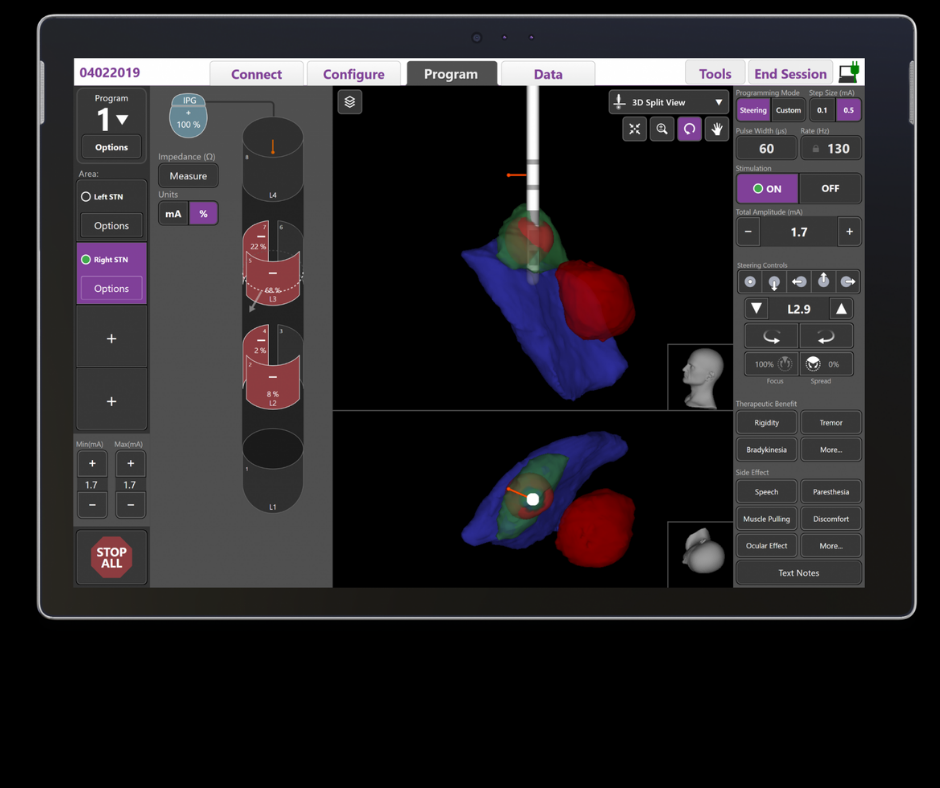 Real-Time Imaging Software for Deep Brain Stimulation Gets FDA Approval