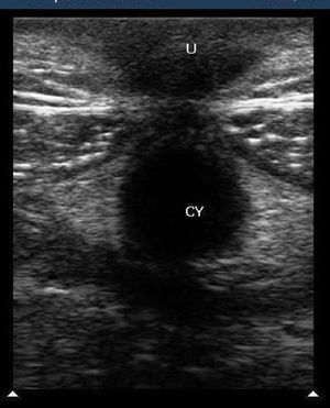Urachal Remnant Abscess 