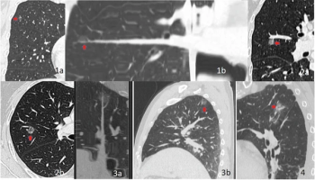 CT Study: Modified Lung-RADS Model Offers Enhanced Prognostic Assessment of Pure Ground-Glass Nodules