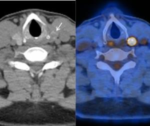 Can PET/CT Bolster Malignancy Detection with Thyroid Incidentalomas?