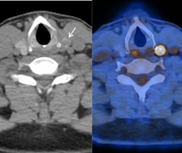 Can PET/CT Bolster Malignancy Detection with Thyroid Incidentalomas?