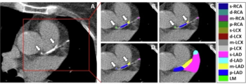 Computed Tomography Study Examines Potential of Automated Coronary Artery Calcium Scoring with Deep Learning