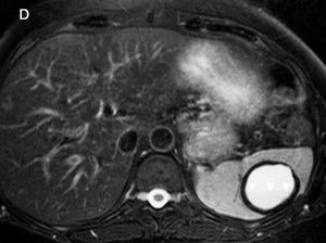 Splenic Hydatid Disease