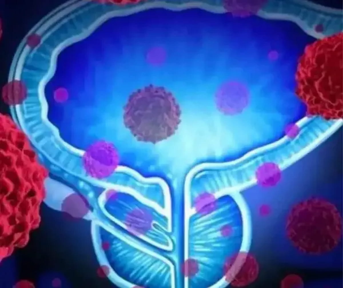 What a New Study Reveals About Actinium-225-PSMA Therapy and Metastatic Castration-Resistant Prostate Cancer