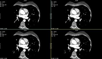 Photon-Counting CT Study Examines Impact of Scan Mode on Radiation Dosing for CCTA in Patients with Non-Acute Chest Pain