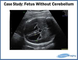 Fetus Without Cerebellum