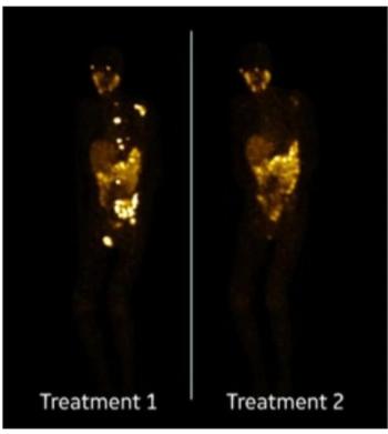 SNMMI: Can Multimodal Monitoring Bolster Outcomes with Pluvicto in Treating mCRPC?