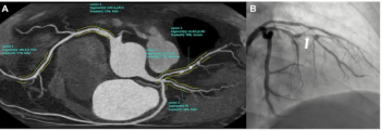 Can Emerging AI Software Offer Detection of CAD on CCTA on Par with Radiologists?