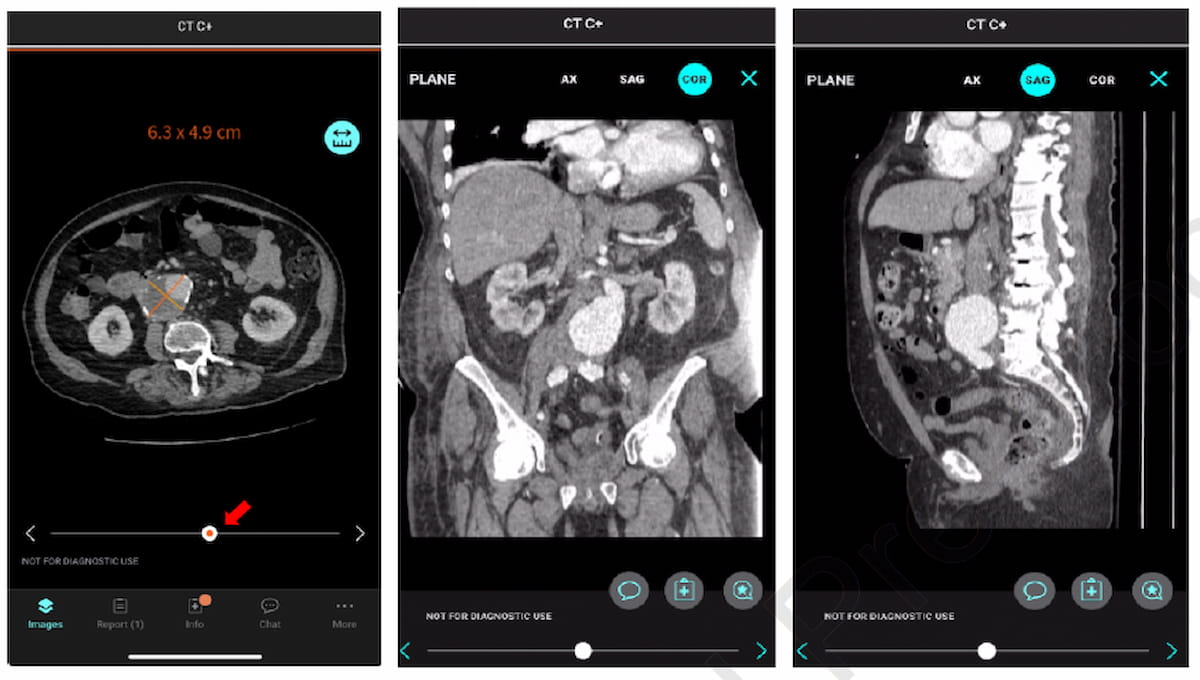 Study Suggests Benefits of CT-Based AI in Detecting and Managing Patients with Aortic Abdominal Aneurysm
