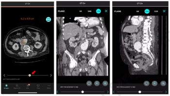 Study Suggests Benefits of CT-Based AI in Detecting and Managing Patients with Aortic Abdominal Aneurysm