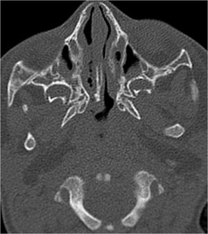 Carotid Body Paraganglioma