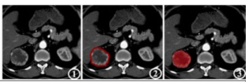 Can CT-Based AI Radiomics Enhance Prediction of Recurrence-Free Survival for Non-Metastatic ccRCC?