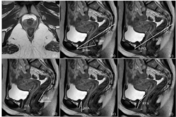 MRI Study Identifies Pelvic Floor Parameters That May Lead to Postpartum Stress Urinary Incontinence