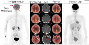 Emerging PET Radiotracer May Enhance Detection of Small Metastases in Patients with Advanced Melanoma