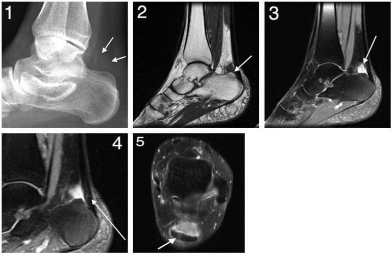 mri of torn tendon in left ankle