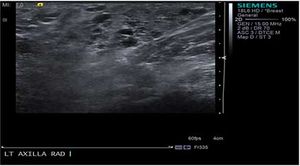 Accessory Axillary Breast Tissue