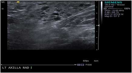 Accessory Axillary Breast Tissue