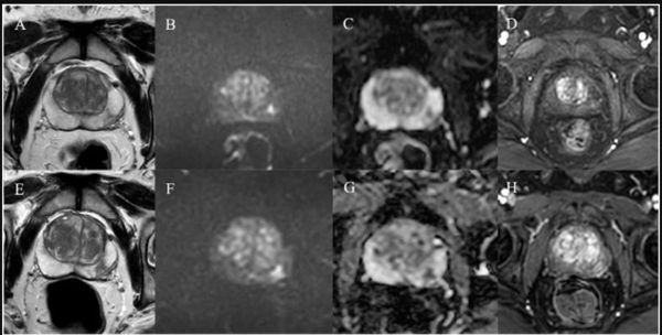 Is bpMRI Sufficient for Assessing PI-RADS 3 Lesions?