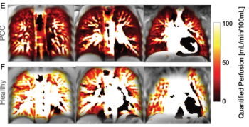 What New Lung MRI Research Reveals About Post-COVID-19 Conditions in Children and Adolescents