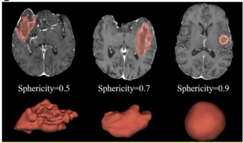 What MRI Research Reveals About Tumor Sphericity in Patients with IDH-Wildtype Glioblastoma